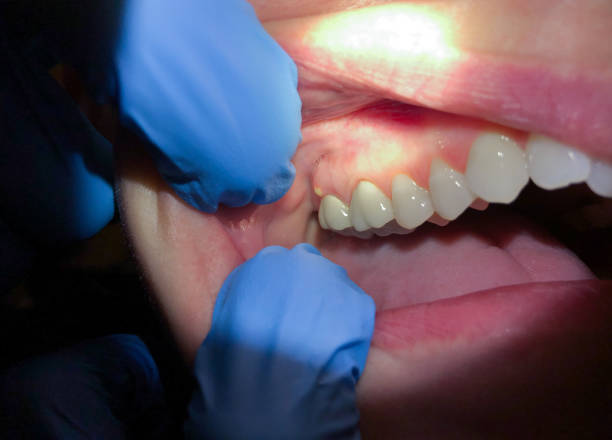Best Broken Tooth Emergency  in London, OH