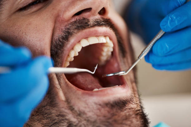 Best Emergency Dental Filling Replacement  in London, OH