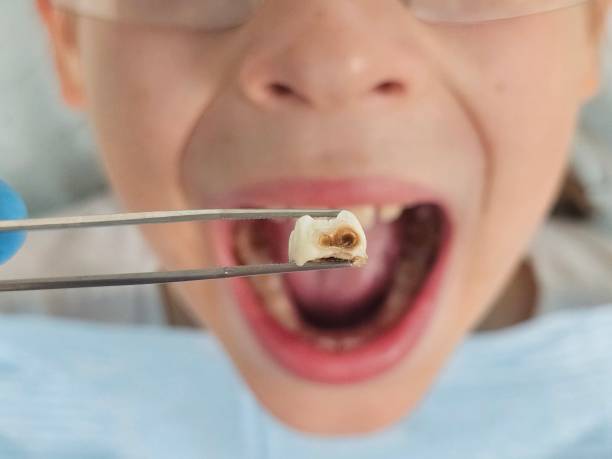 Best Teeth Whitening  in London, OH