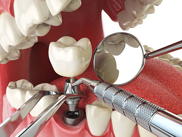Best Broken Tooth Emergency  in London, OH